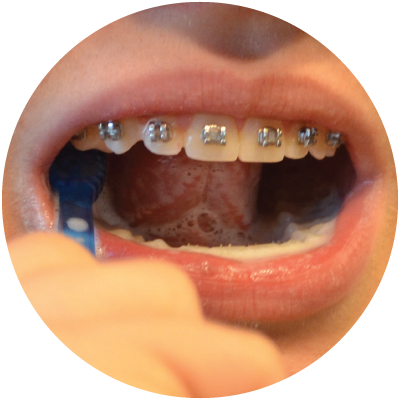 Brush around braces without a wire