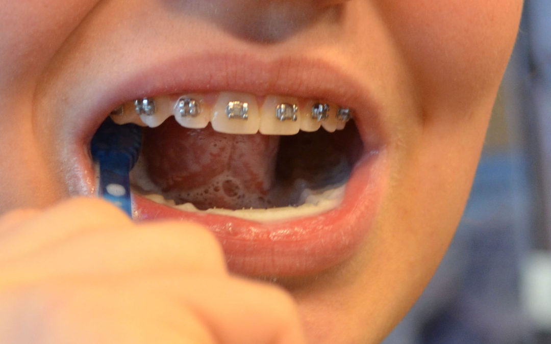 Caring for Teeth with Braces