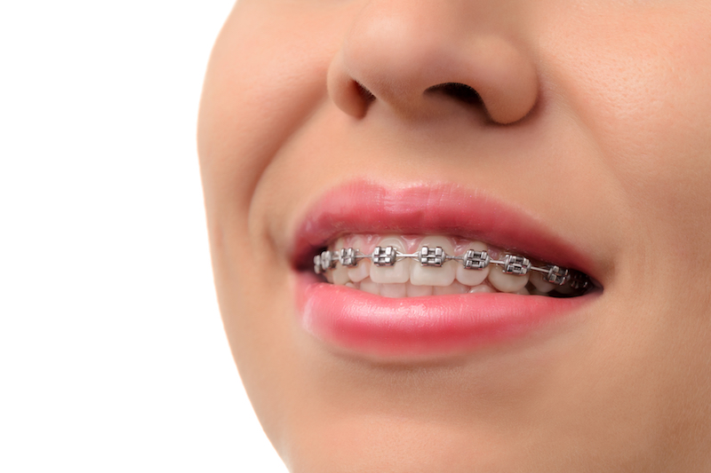 Metal Braces in Saratoga Springs Utah