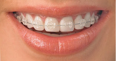 Orthodontic Options Clarity Braces