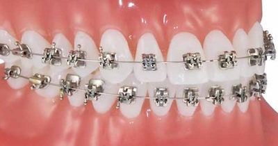 Orthodontic Options Damon Brackets