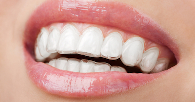 Orthodontic Options Invisalign