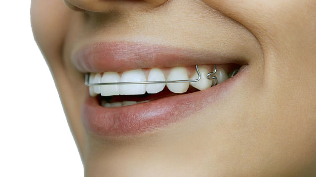 Phase 2 Orthodontics