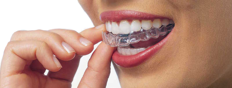 Using Invisalign Aligners