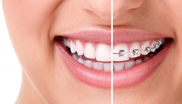 Utah Invisalign and Clarity Braces