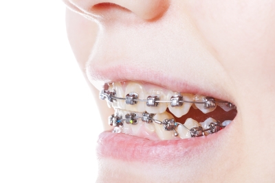 Using Invisalign Aligners